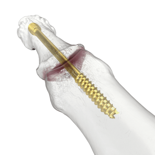 Extremidades superiores CCS SpeedTip