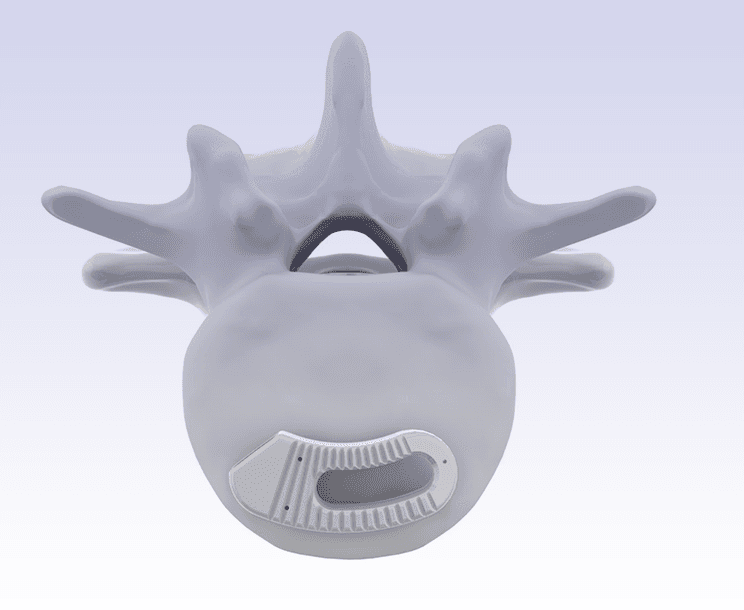 Sistema de fusión intervértebral lumbar - Adonis®-TLIF