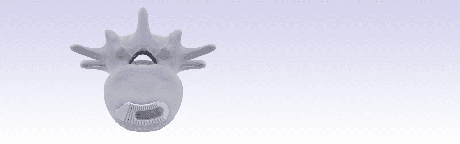 Sistema de fusión intervértebral lumbar - Adonis®-TLIF