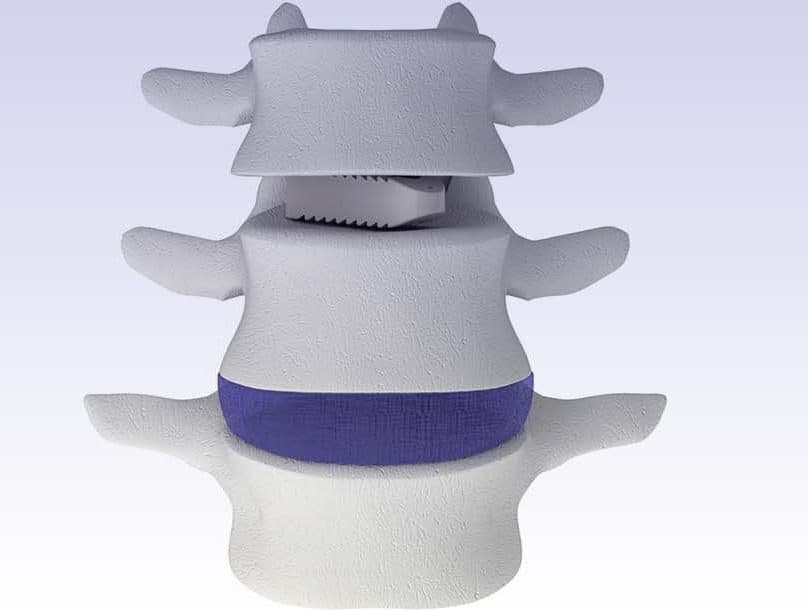 Sistema de fusión intervértebral lumbar - Adonis®-UniLIF