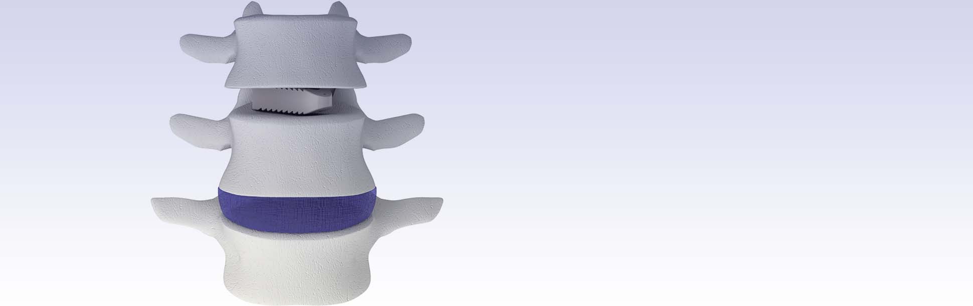 Sistema de fusión intervértebral lumbar - Adonis®-UniLIF