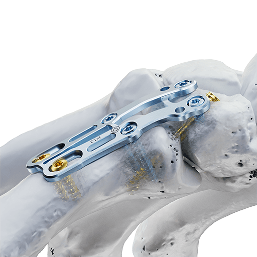 Sistema de fusión CMC-I 2.0, 3.0