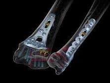 Distal Radius and Distal Ulna System 2.5
