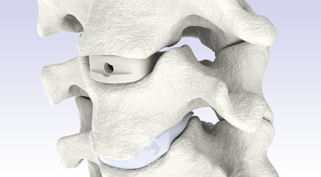 Sistema de fusión de vértebras intermedias cervicales - TRISTAN®