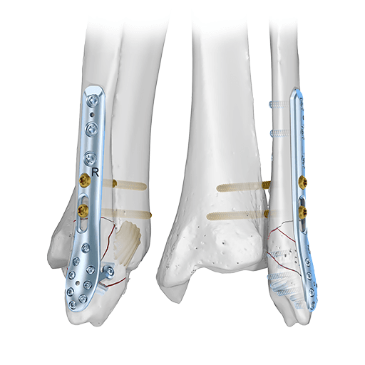 Sistema Ankle Trauma 2.8/3.5