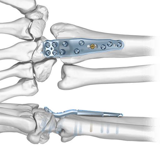 Sistema de artrodesis 2.0/2.3, 2.5