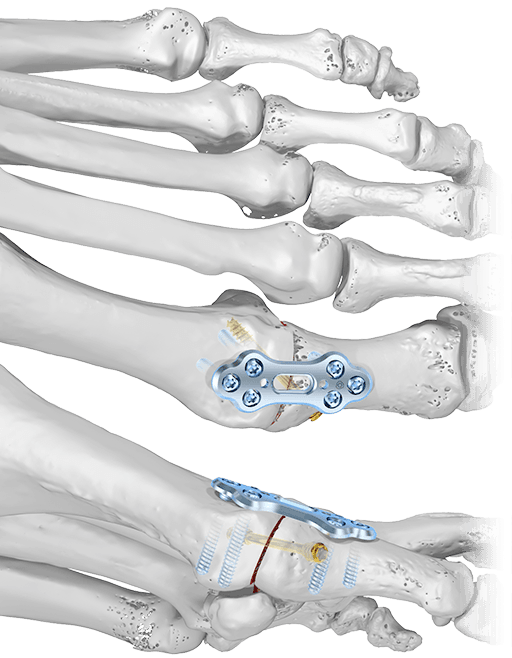 Fore- and Midfoot System 2.0/2.3, 2.8