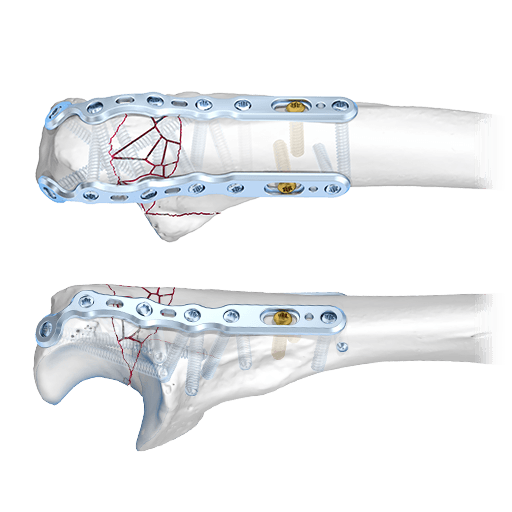 Sistema de olécranon 2.8