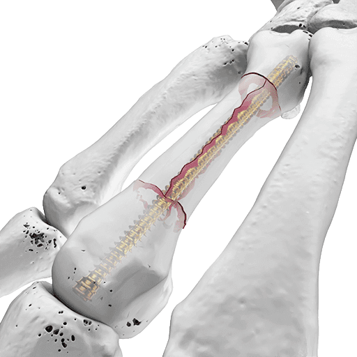 Extremidades superiores CCS SpeedTip