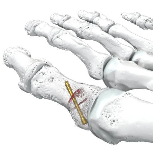 Extremidades inferiores CCS SpeedTip